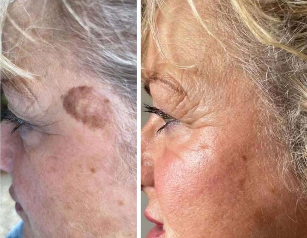 Age spot on temple before and after cryotherapy