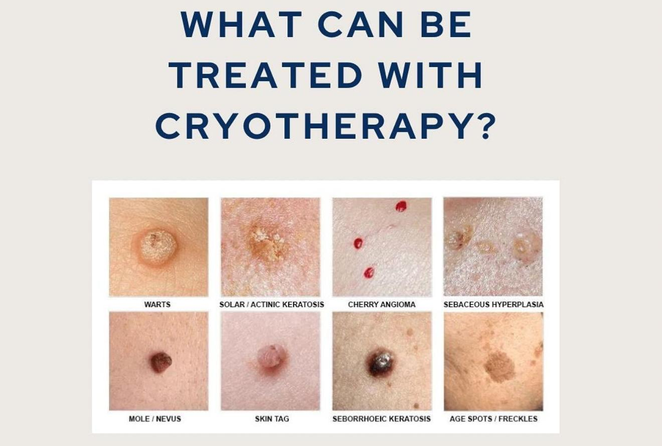 What can be treated with cryotherapy: warts, solar keratosis, cherry angioma, sebaceous hyperplasia, moles, skin tags, seborrheic keratosis, age spots