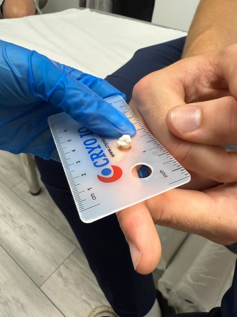 Cryotherapy in progress showing temporary frost icicle effect on skin