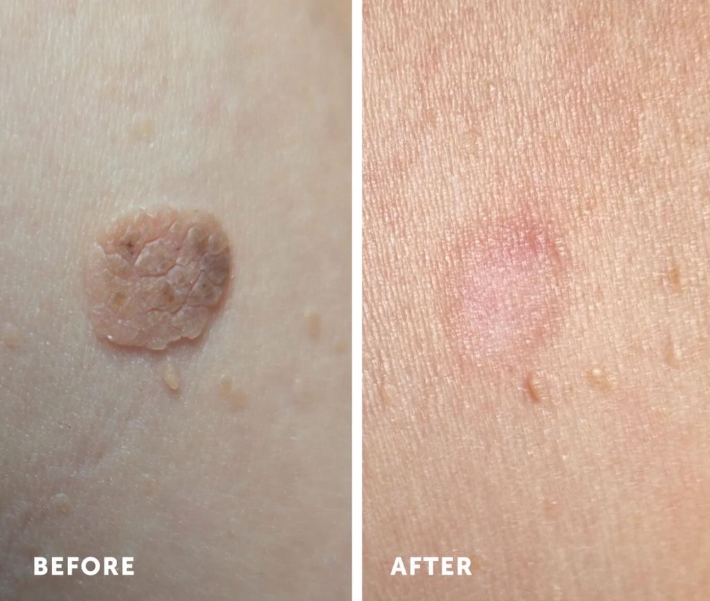 Seborrheic keratosis before and after cryotherapy on face