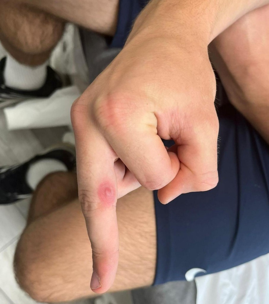 Index finger after first cryotherapy session