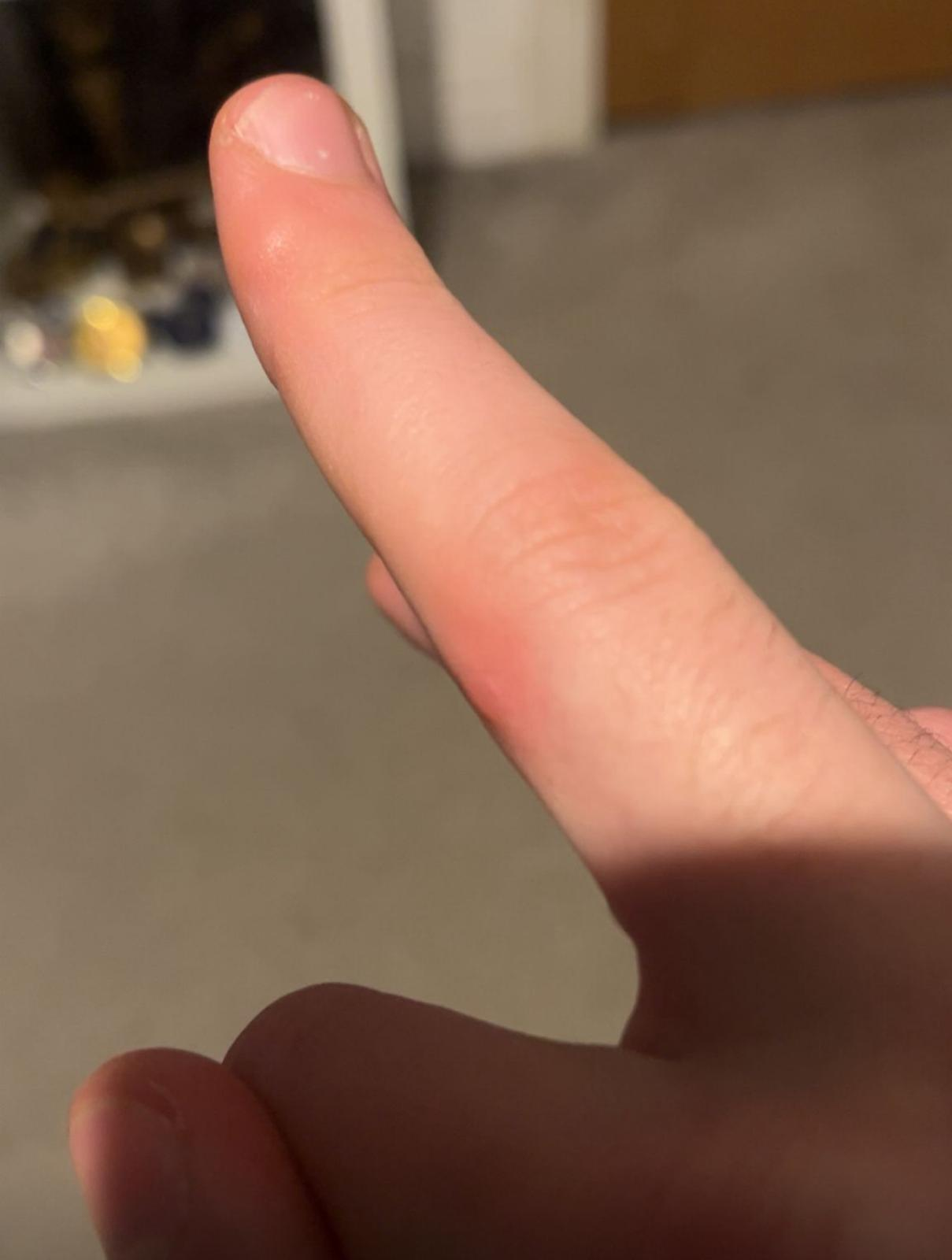 Index finger after second cryotherapy session, lesion resolved