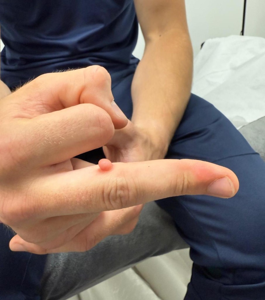 Skin tag on index finger before cryotherapy