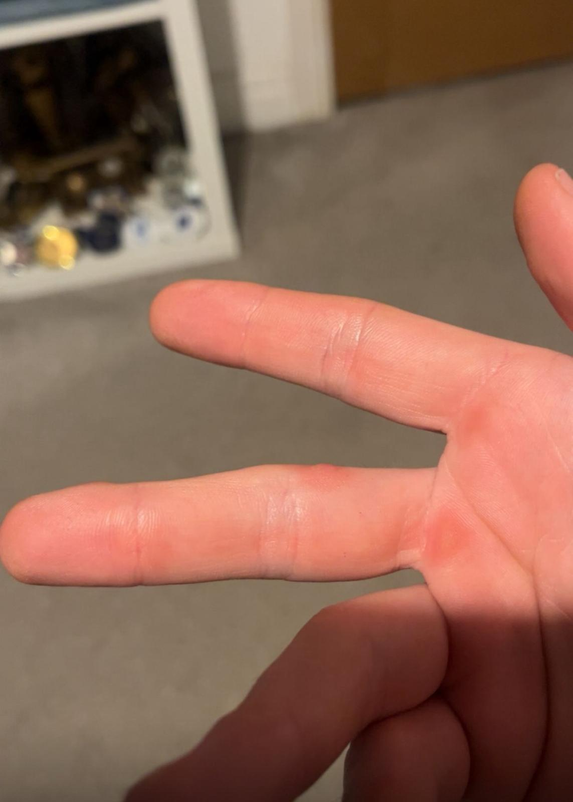 Wart on finger and healed palm sites after cryotherapy