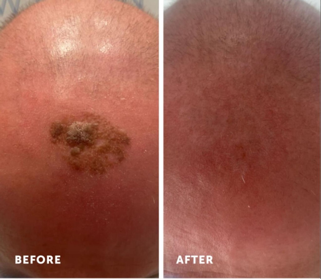 Seborrheic keratosis on scalp: before and six weeks after two cryotherapy sessions